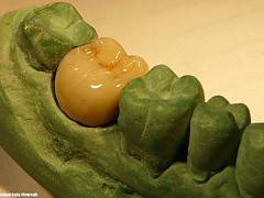 Как мне распечатали зубную коронку на 3D-принтере