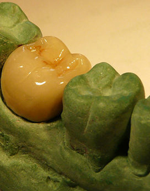 Как мне распечатали зубную коронку на 3D-принтере